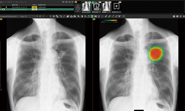 AIを活用した画像診断支援ソフトウェアが「CXR-AID」の画像イメージ